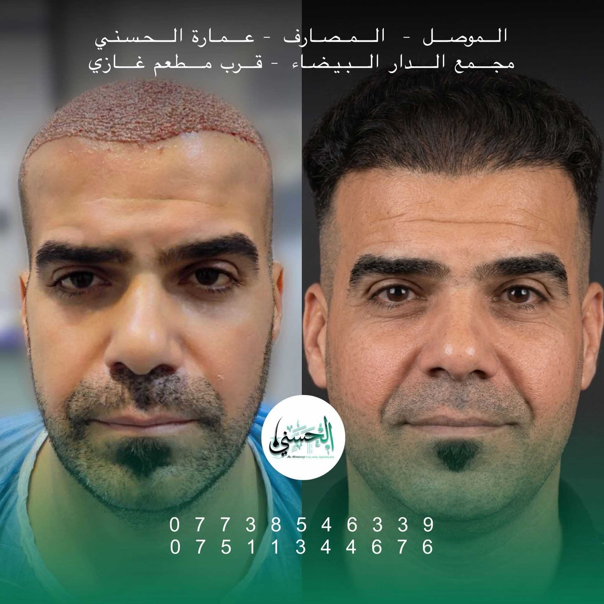 نتيجة زراعة الشعر قبل وبعد — عيادة الحسني الموصل — 01