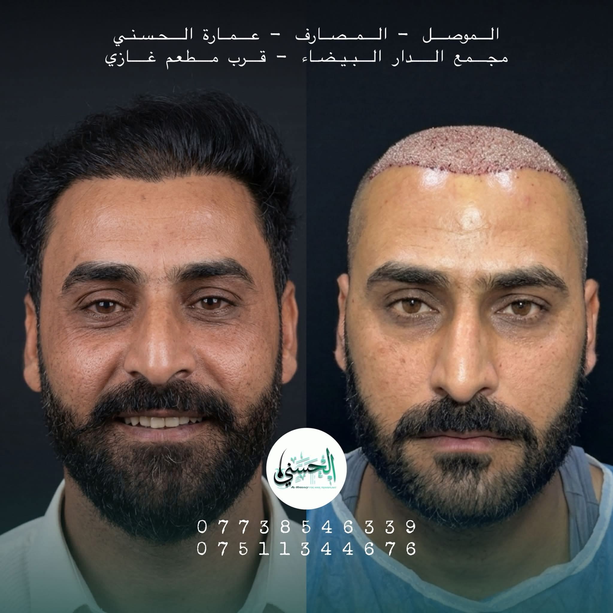 نتيجة زراعة الشعر قبل وبعد — عيادة الحسني الموصل — 02