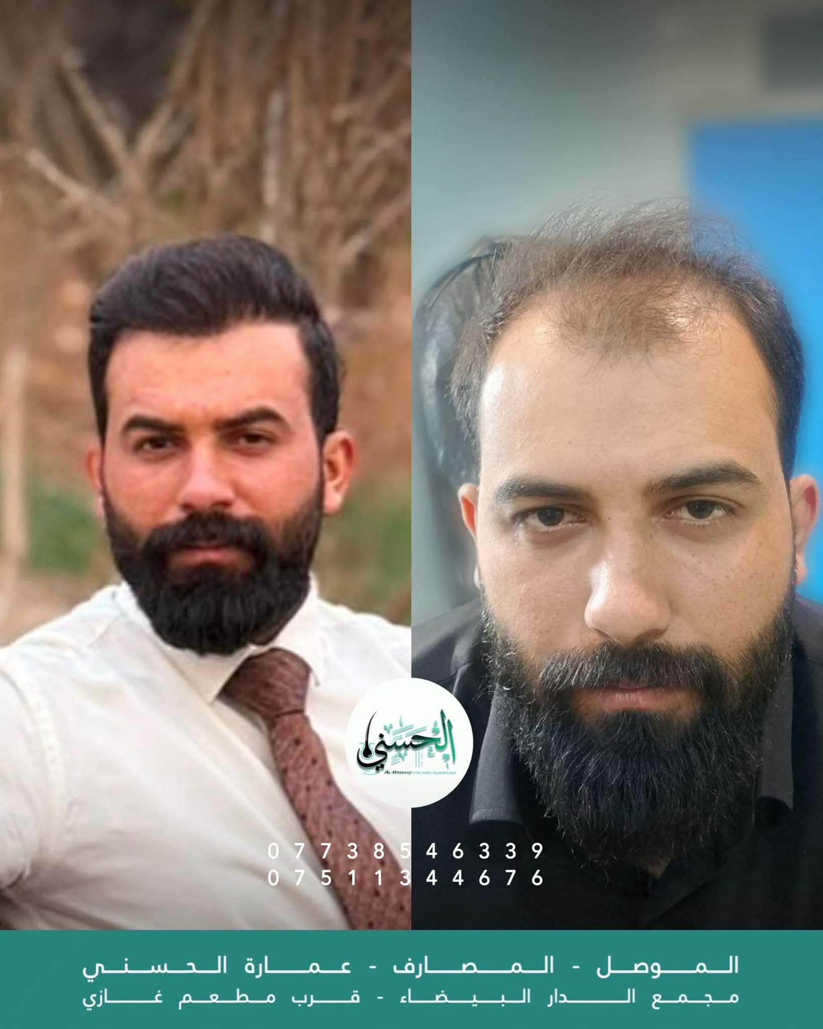 نتيجة زراعة الشعر قبل وبعد — عيادة الحسني الموصل — 03