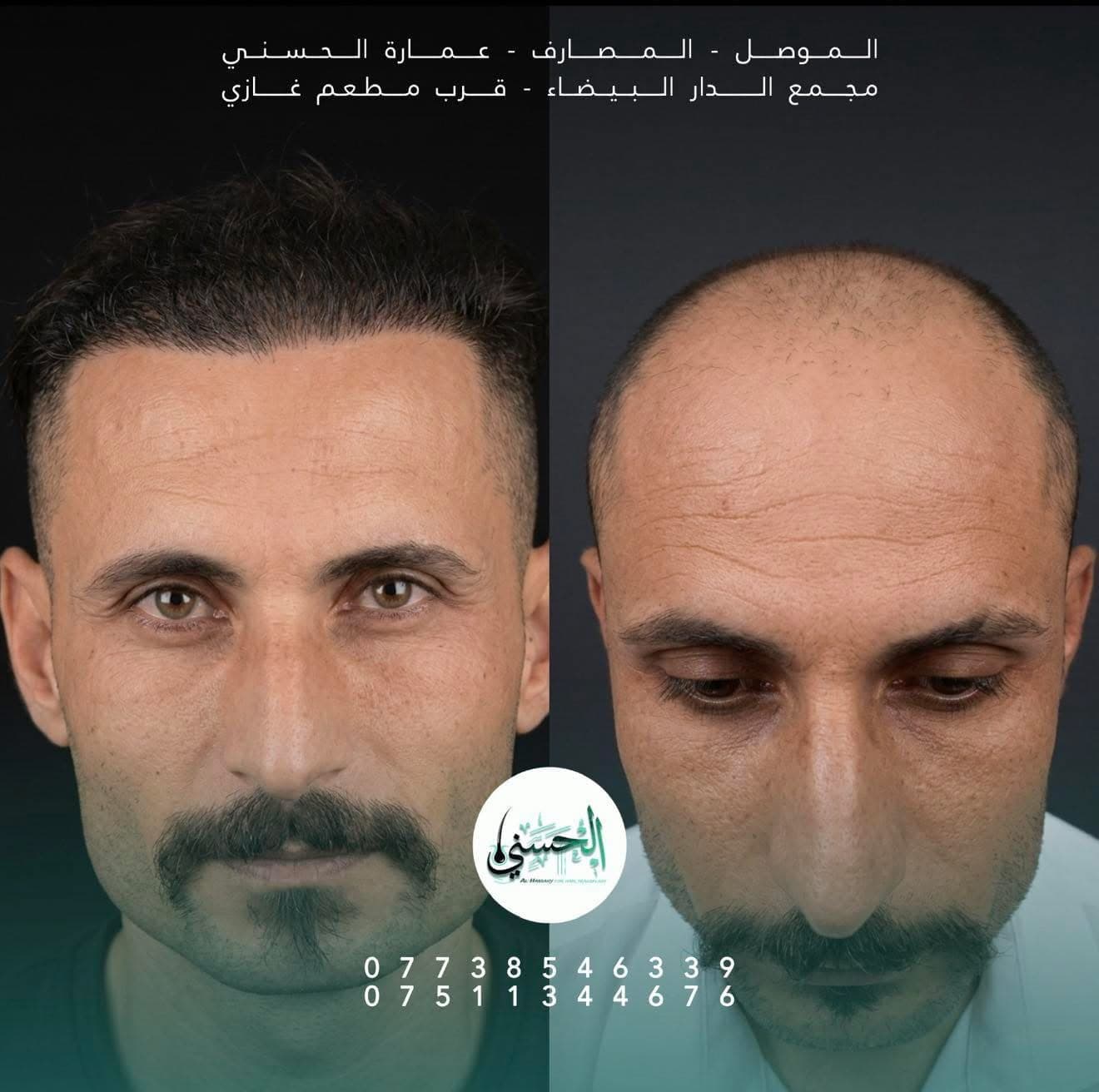 نتيجة زراعة الشعر قبل وبعد — عيادة الحسني الموصل — 04