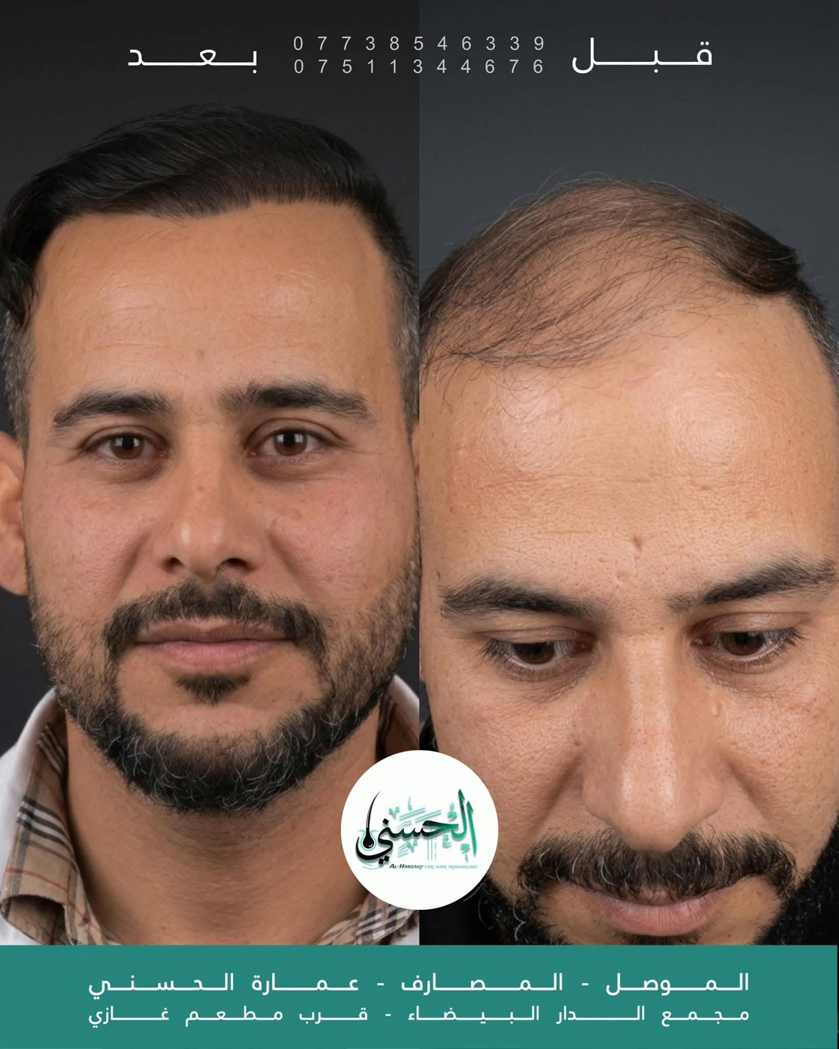 نتيجة زراعة الشعر قبل وبعد — عيادة الحسني الموصل — 05