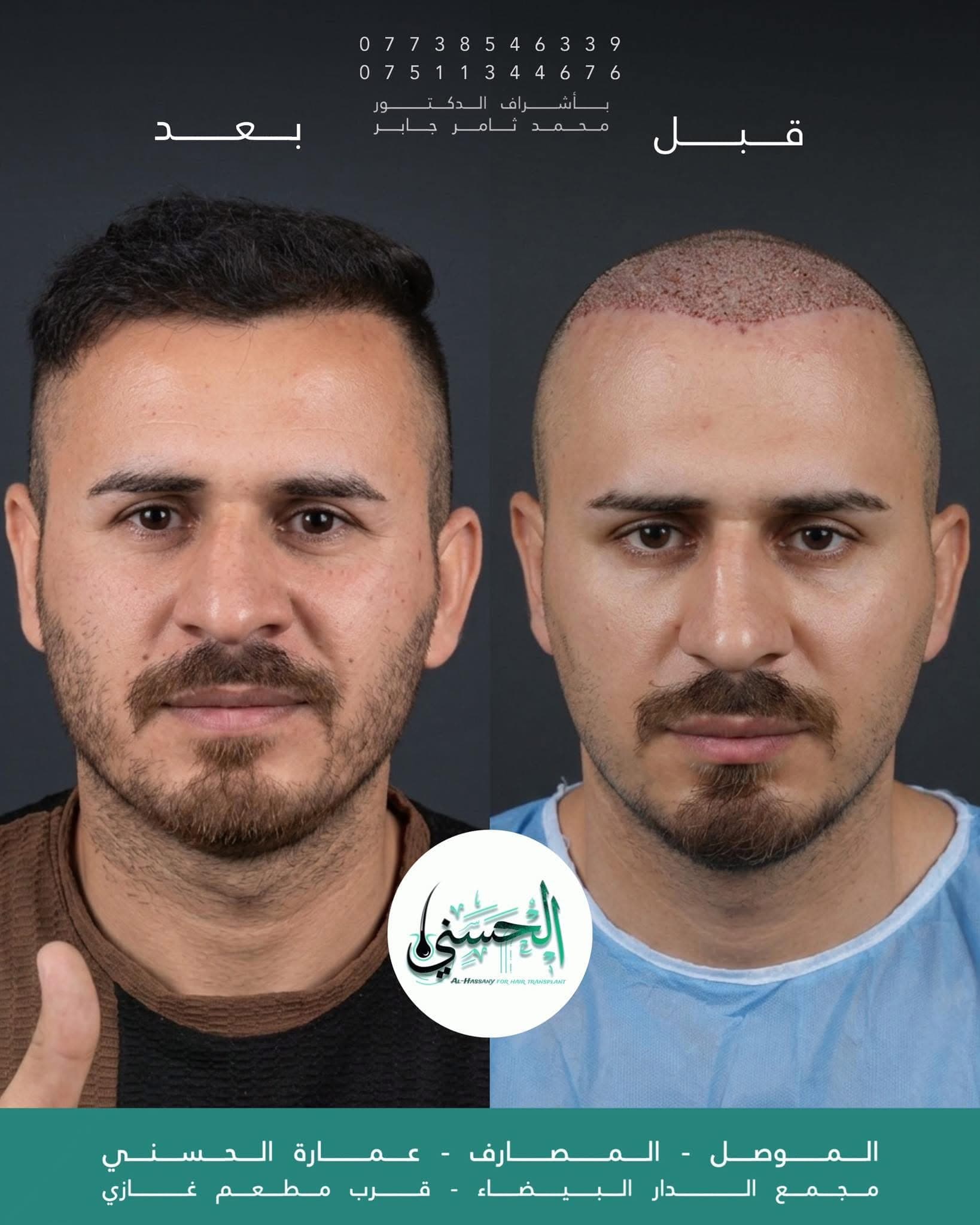 نتيجة زراعة الشعر قبل وبعد — عيادة الحسني الموصل — 06