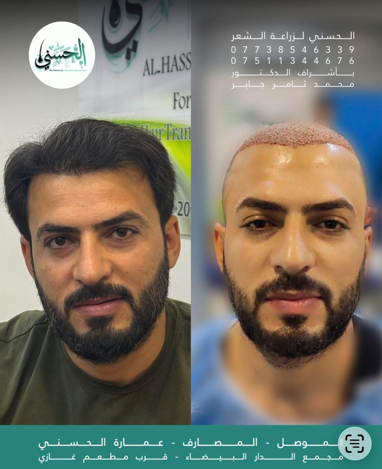 نتيجة زراعة الشعر قبل وبعد — عيادة الحسني الموصل — 07