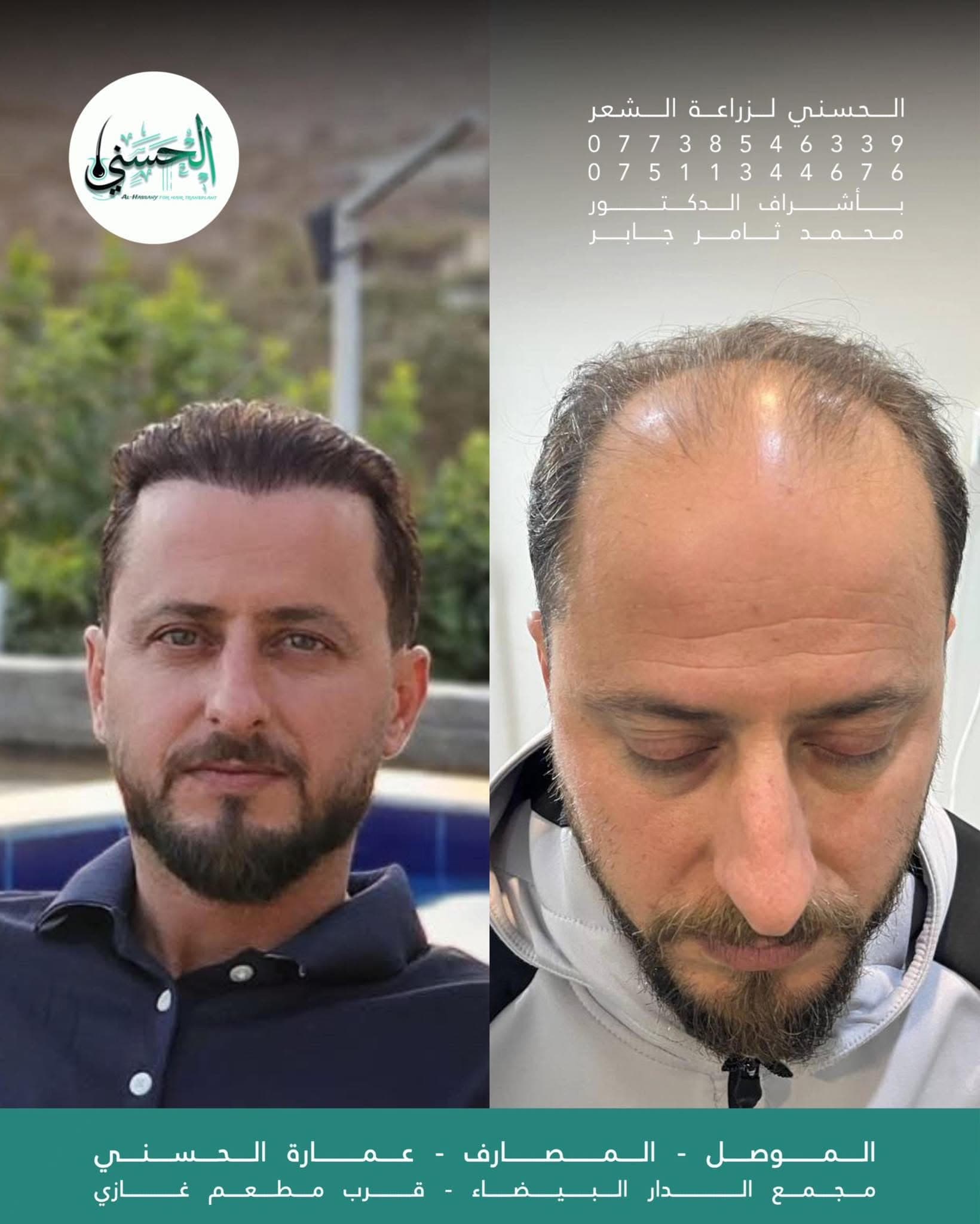 نتيجة زراعة الشعر قبل وبعد — عيادة الحسني الموصل — 08