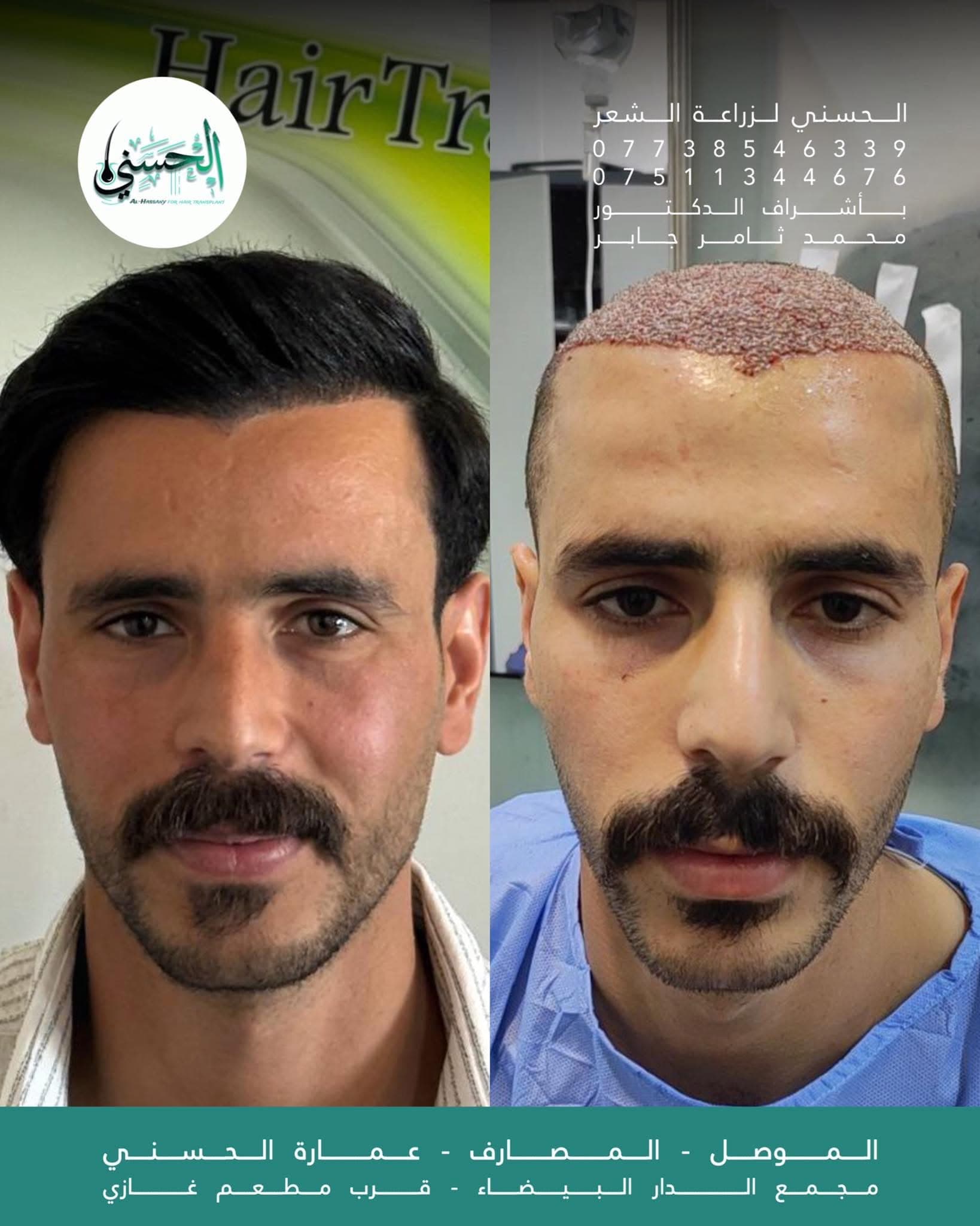نتيجة زراعة الشعر قبل وبعد — عيادة الحسني الموصل — 09