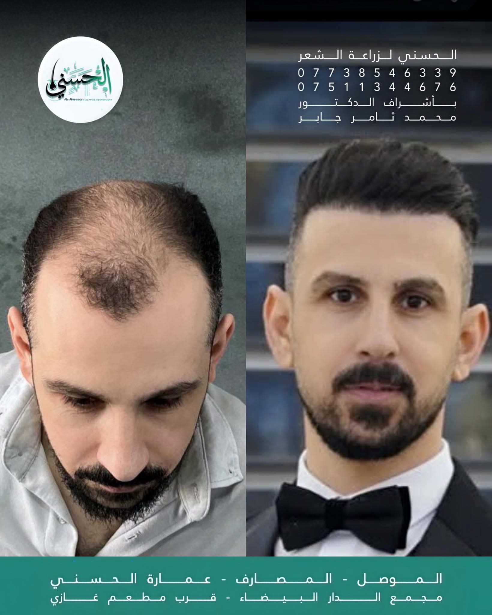 نتيجة زراعة الشعر قبل وبعد — عيادة الحسني الموصل — 10