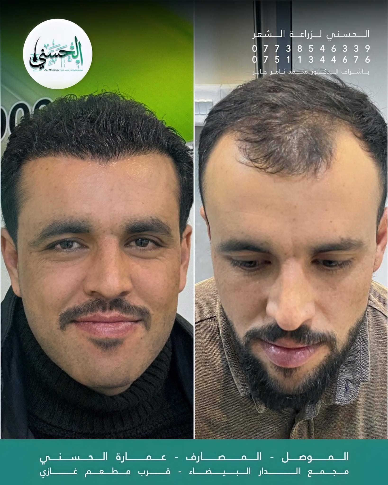نتيجة زراعة الشعر قبل وبعد — عيادة الحسني الموصل — 11