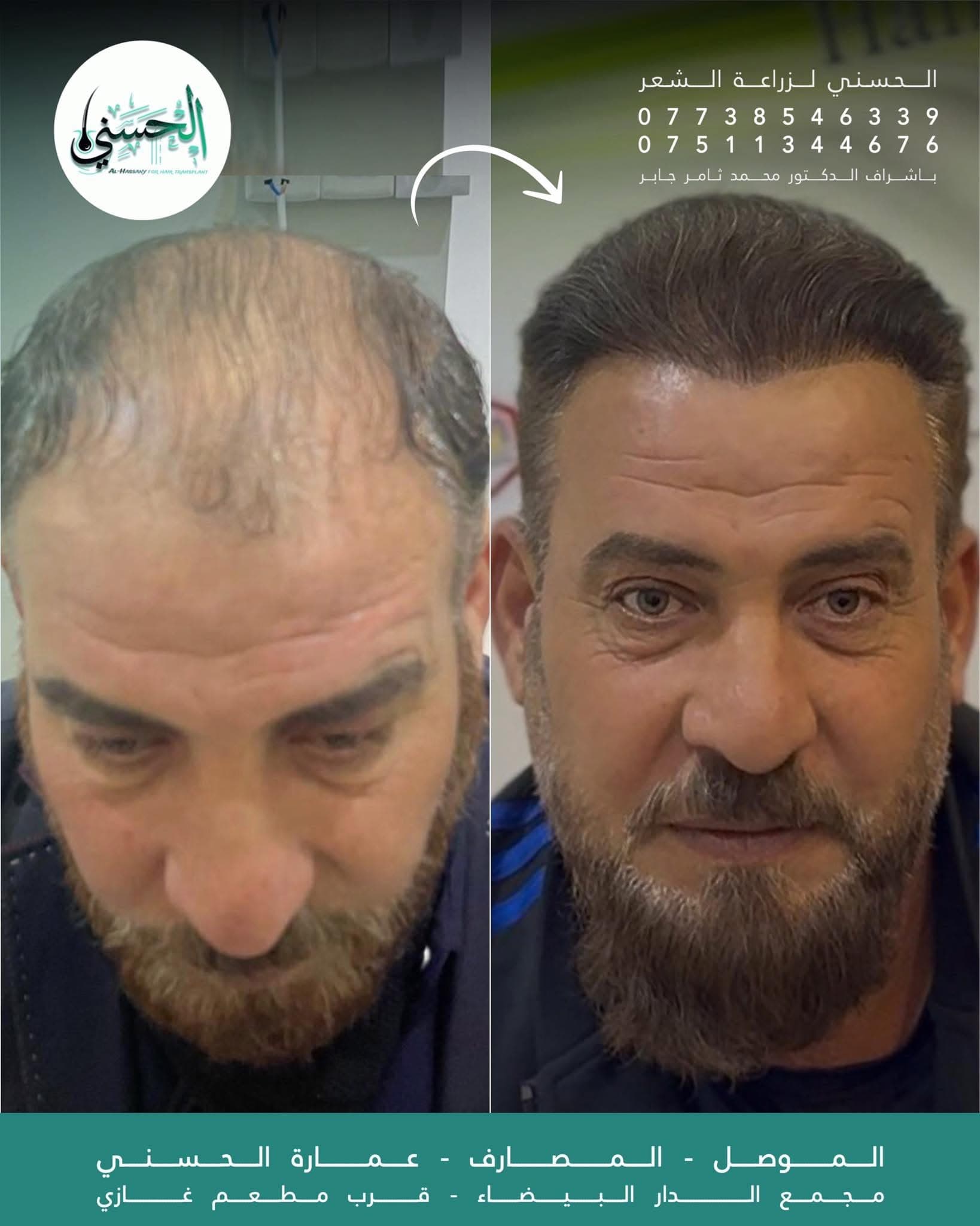 نتيجة زراعة الشعر قبل وبعد — عيادة الحسني الموصل — 12