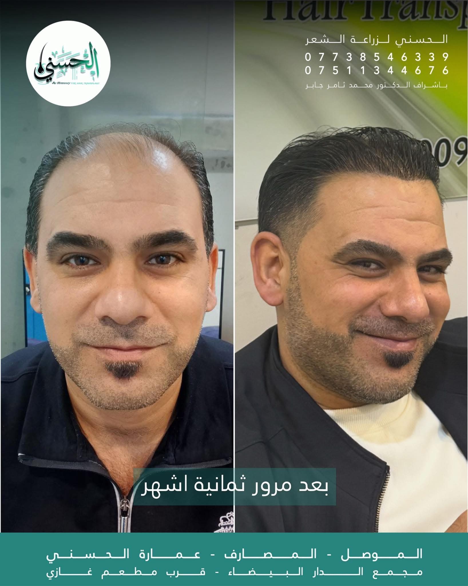 نتيجة زراعة الشعر قبل وبعد — عيادة الحسني الموصل — 13