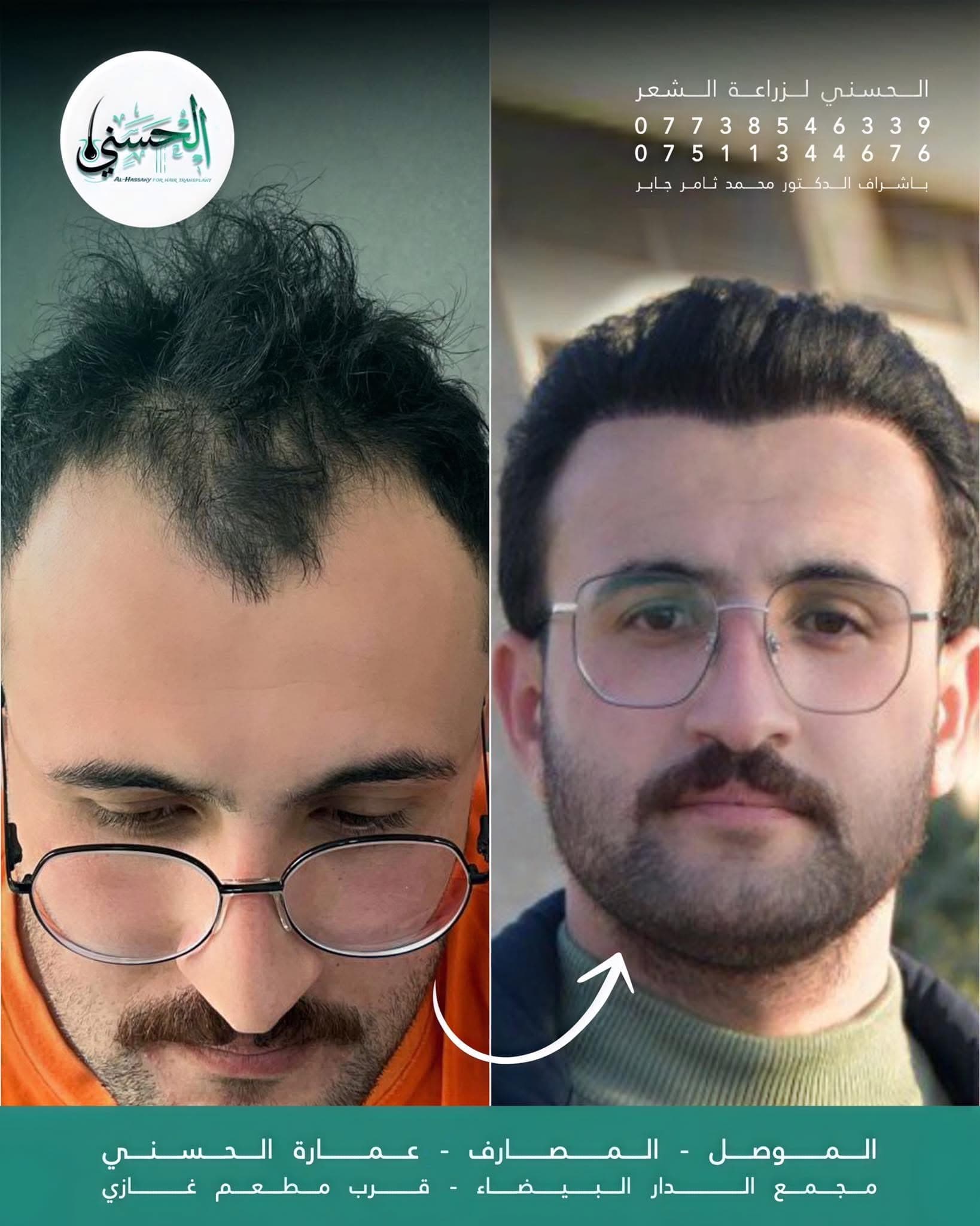 نتيجة زراعة الشعر قبل وبعد — عيادة الحسني الموصل — 14