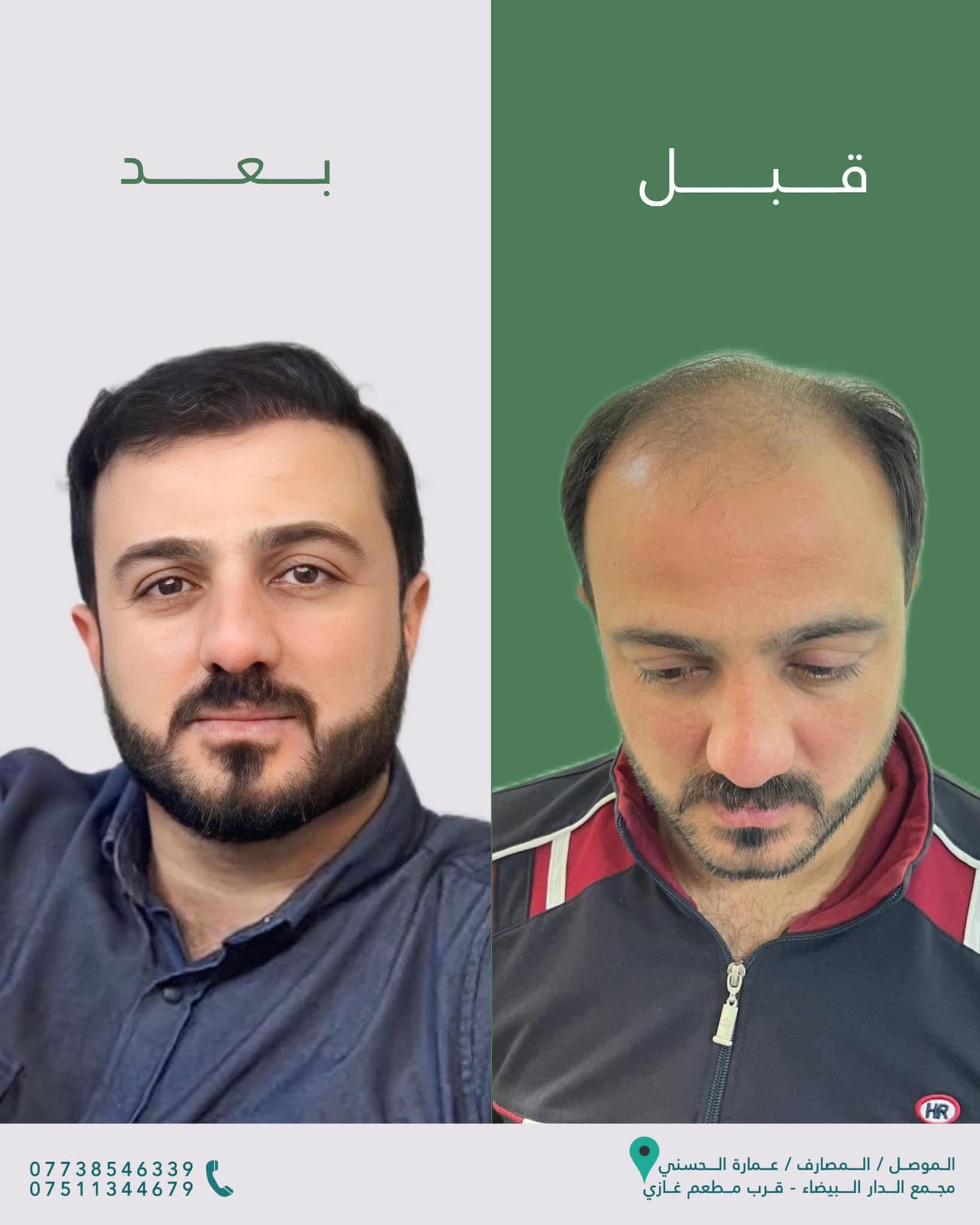 نتيجة زراعة الشعر قبل وبعد — عيادة الحسني الموصل — 15