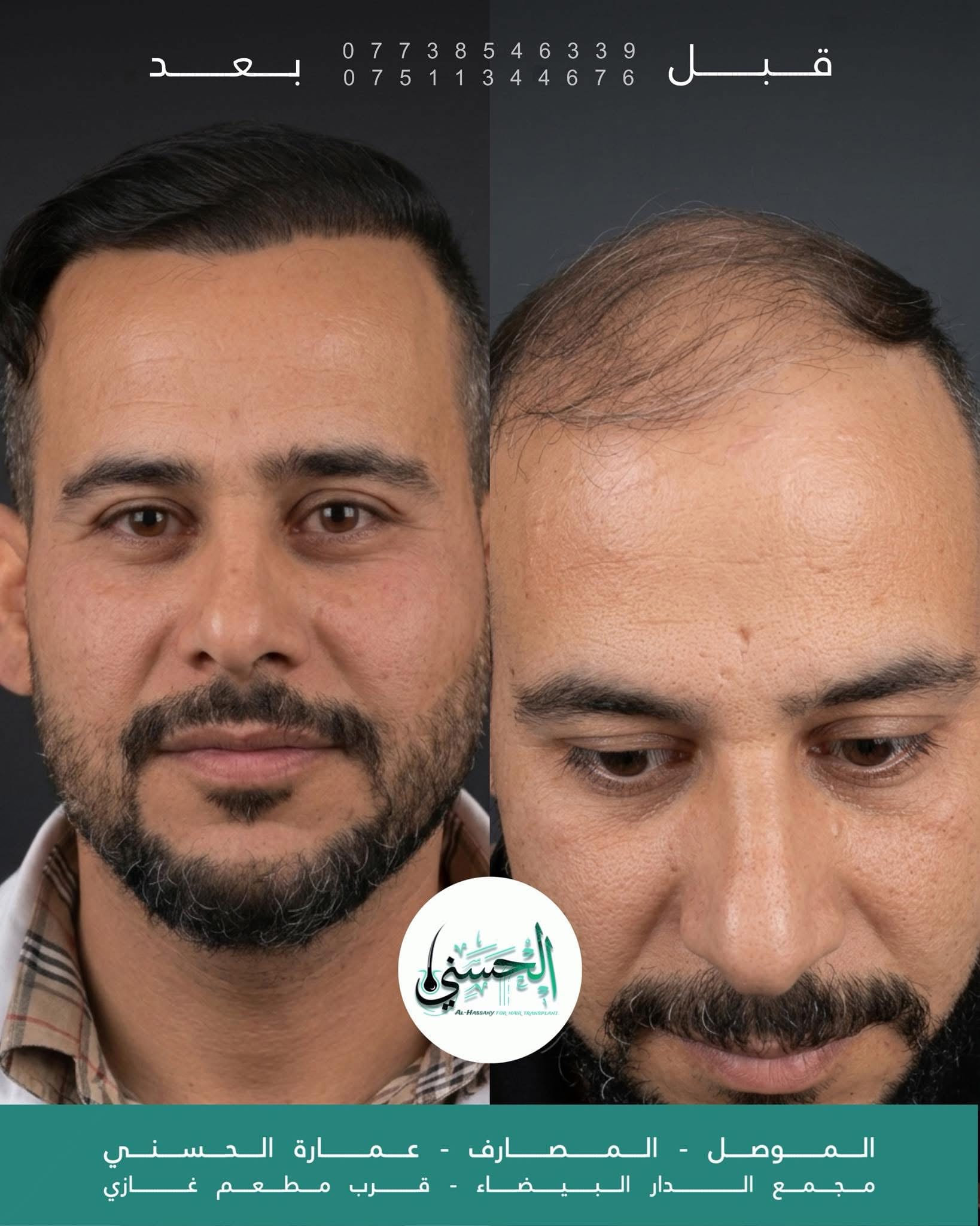 نتيجة زراعة الشعر قبل وبعد — عيادة الحسني الموصل — 04